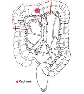 Resezione segmentaria del trasverso
