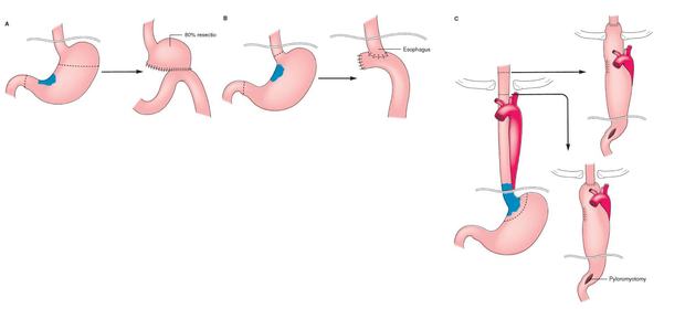 a) gastrectomia subtotale sec. Billroth II  b) gastrectomia totale con ansa interposta  c) esofagogastrectomia totale con ricostruzione cervicale o toracica