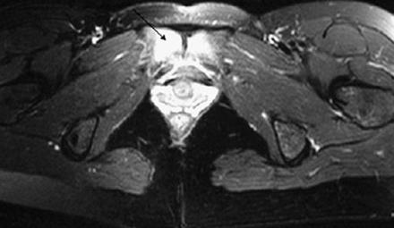 Presenza di edema osseo a livello della sinfisi pubica
