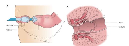 anastomosi tra il colon ed il retto residuo
