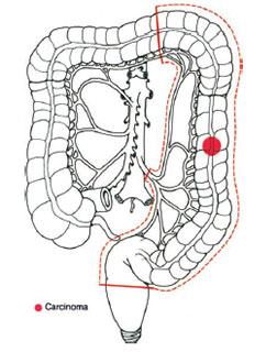 Emicolectomia sinistra per lesioni del colon sinistro